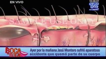 Jasú Montero tiene quemaduras de primer y segundo grado en el 50% de su cuerpo