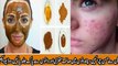 Anti Acne Honey And Cinnamon Mask for Face Pimples