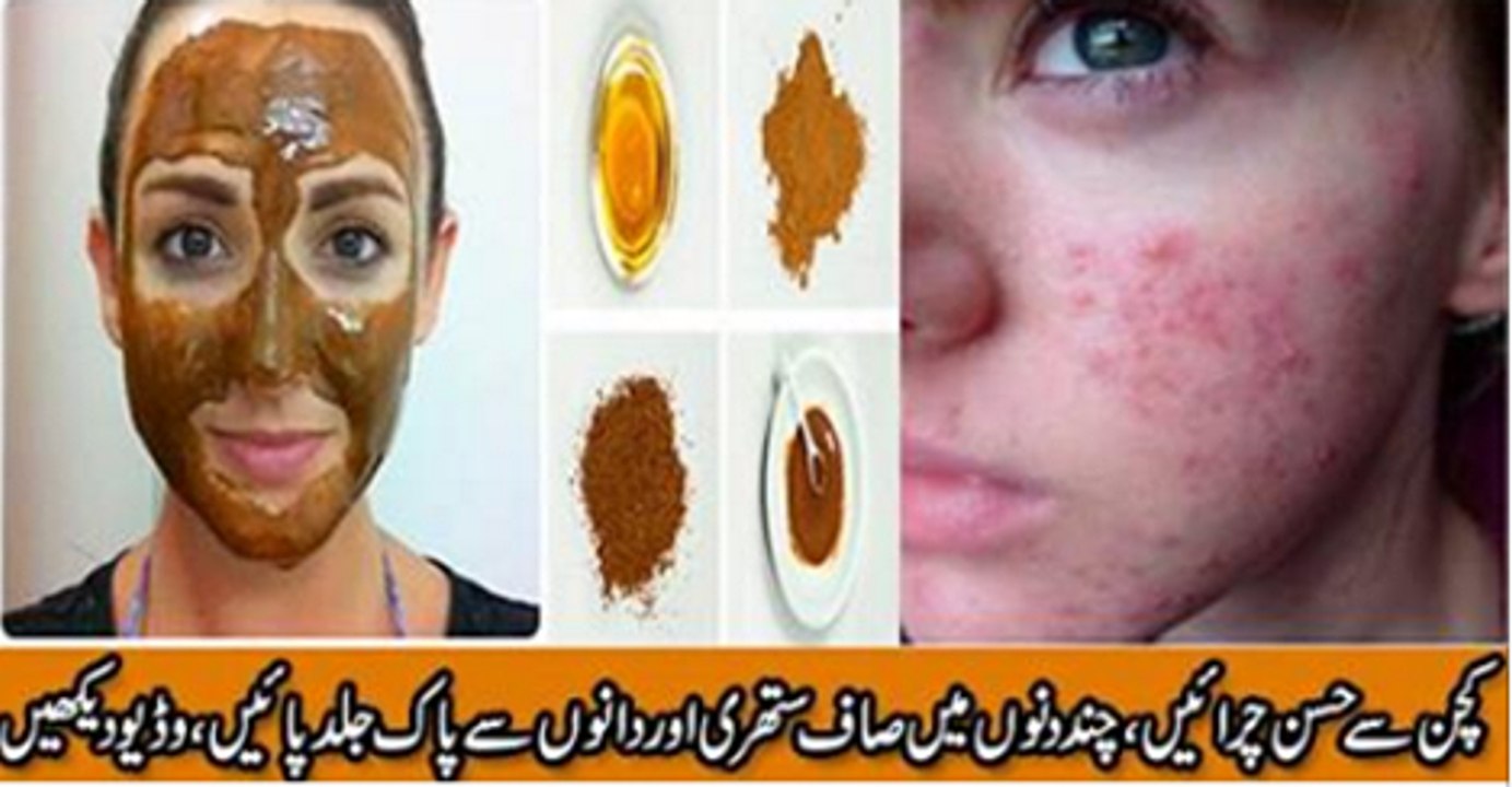 Anti Acne Honey And Cinnamon Mask for Face Pimples video Dailymotion