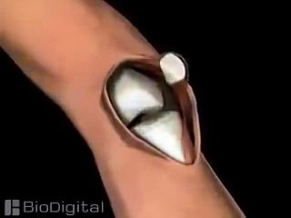 "..Medical Animation of a Knee Replacement.. - GVP.."