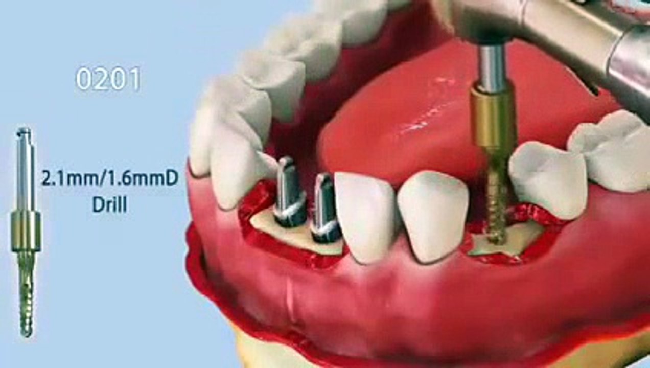 "..Tooth Implant.. - GVP.."