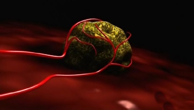 Онкологические заболевания. Рак: причины, профилактика, лечение. Часть 2