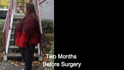 500 Lb Woman Loses Over 300 Lbs in 2 Years