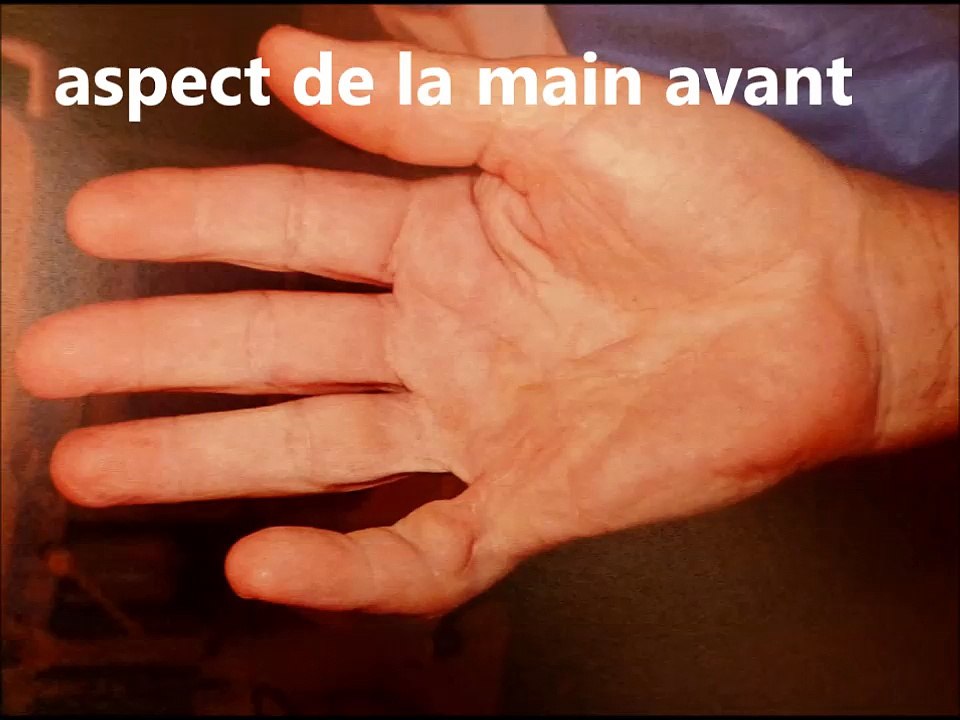 maladie de Dupuytren, opération par vladimir mitz