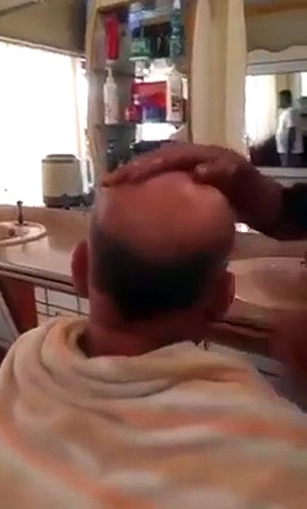 very funny way .. baldness cure in India