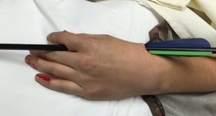 Retirer une flèche dans une main