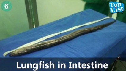 10 Horrifying Things Ever found Living Inside a Human Body [HD]