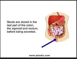 Ulcerative Colitis