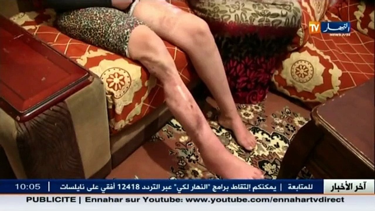 طفولة مريم تنتهي بسبب عضة كلب مفترس ... من المسؤول ؟؟