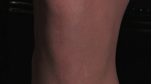 Ski - Mes cicatrices #3 : Julien Lizeroux et sa désinsertion partielle du tendon quadricipital