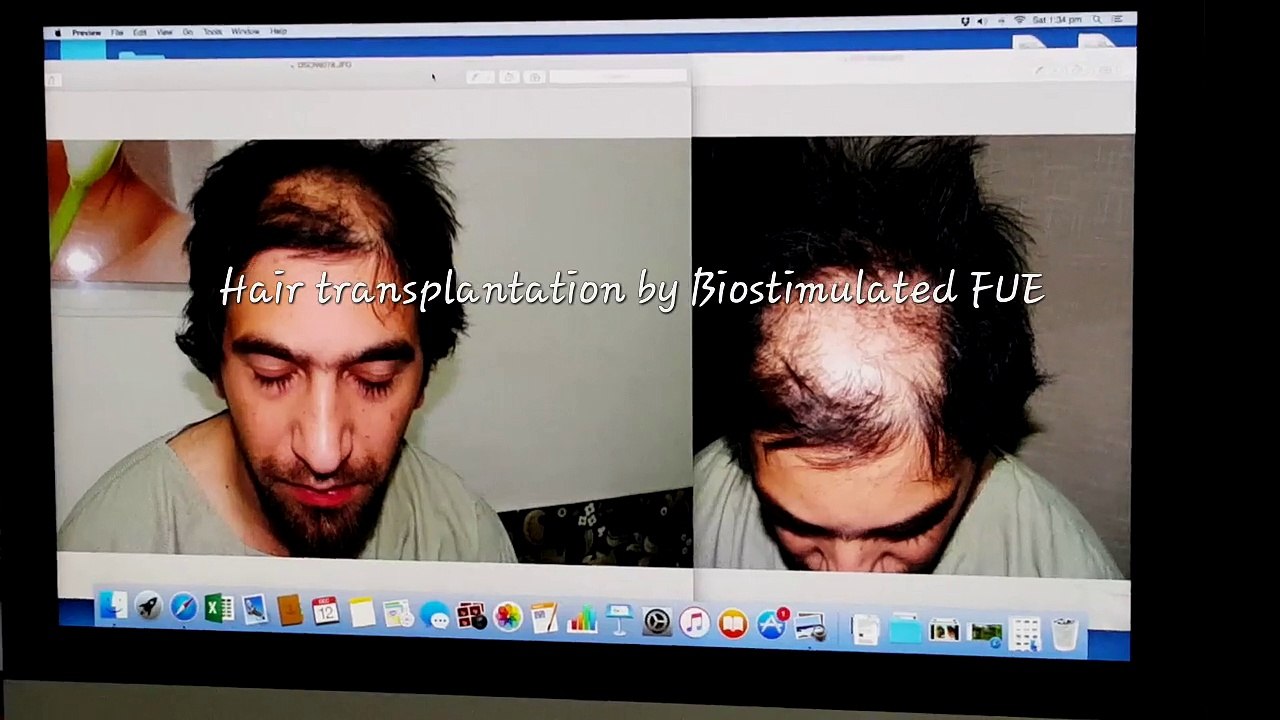 Best FUE Hair Transplant Results In Delhi India - Dr.Amrendra Kumar
