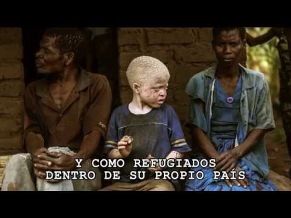 Mutilación y muerte: el destino de nacer albino en África