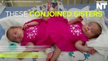 These Conjoined Sisters Could Be Separated Soon