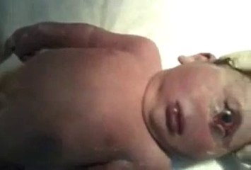 Baby born with one eye and no nose???