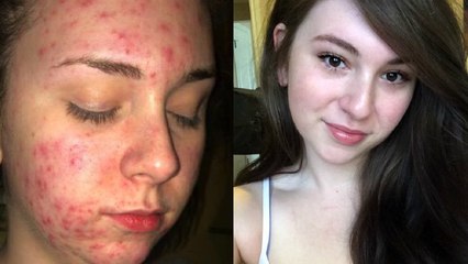 How to Get Rid of Acne on Your Back.