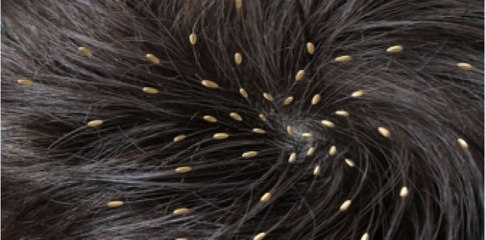 How to Get Rid of Head Lice Fast