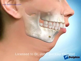 Çene Düşmesi Nasıl Tedavi Edilir?