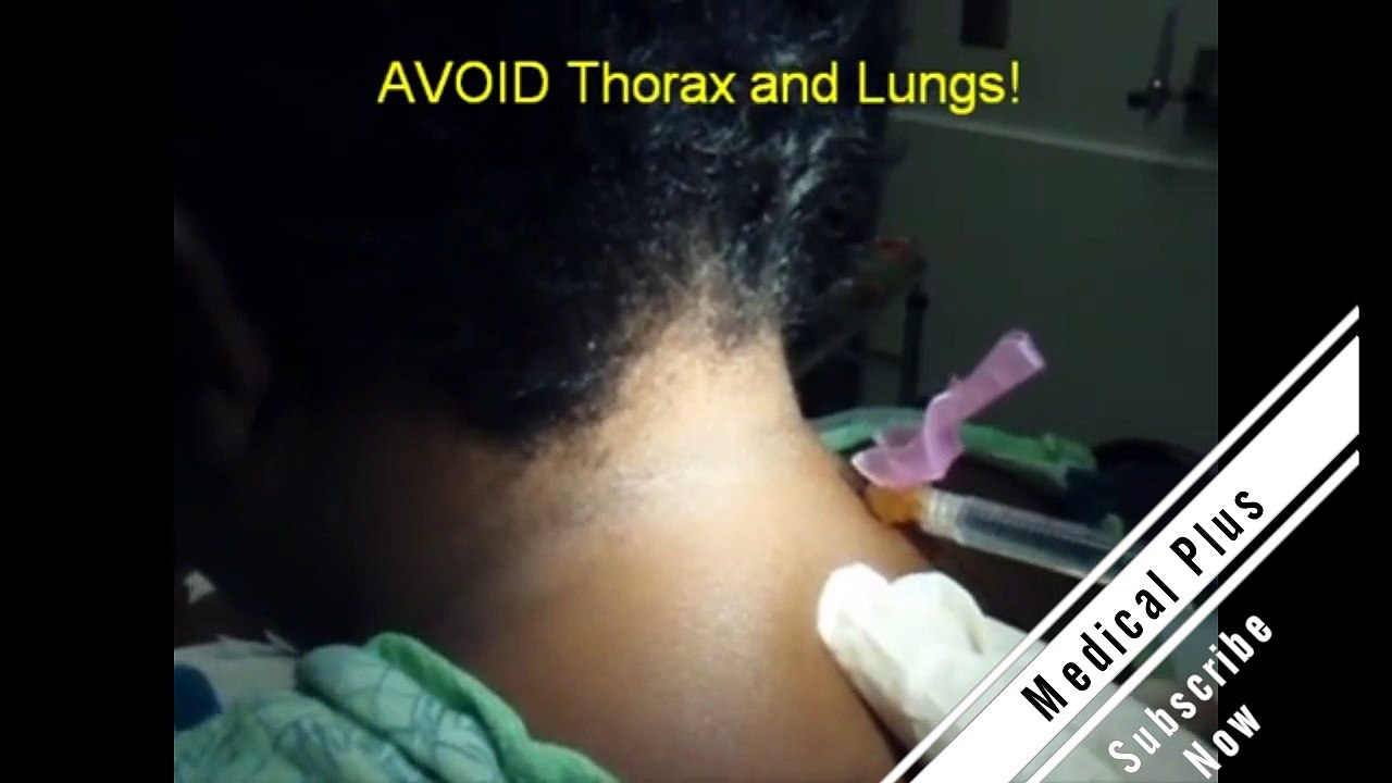The Cervical Injection