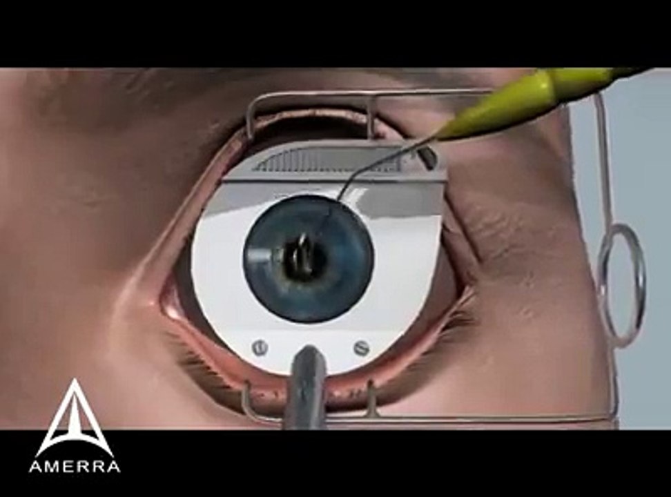 Open Eye Surgary