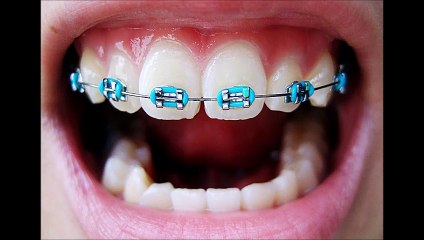 Diş Teli Fiyatları