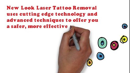 Houston laser tattoo removal