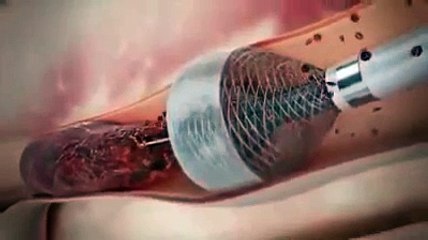 Cardiac Catheterization