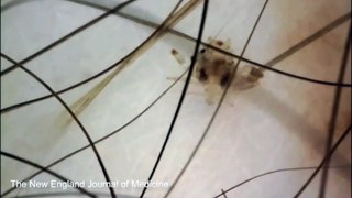 CHILLING video of crab louse that lived in man for 3 MONTHS