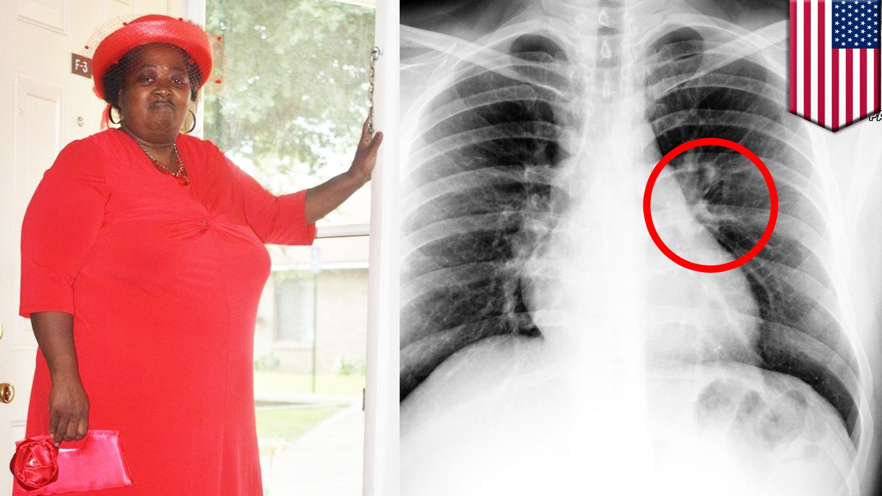 Sick black woman arrested, removed from hospital, dies of blood clot in lung