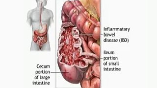 Inflammatory Bowel Disease