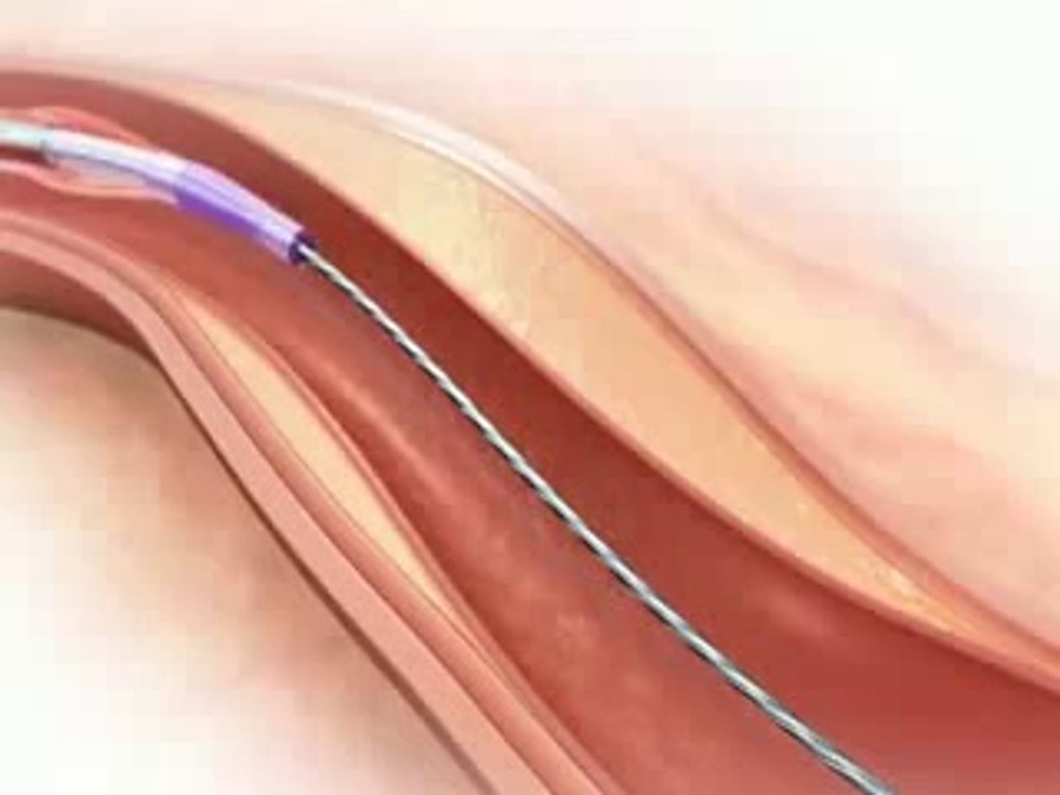 PTCA