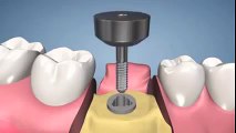 Dental Implants Dubai - Lookswoow Dental Clinic