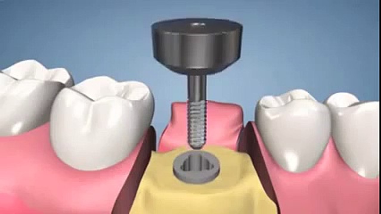 Dental Implants Dubai - Lookswoow Dental Clinic