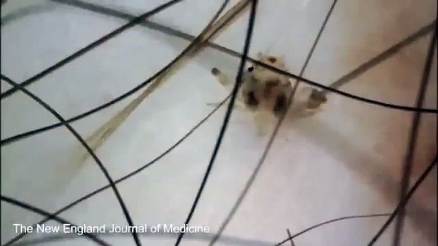 Vidéo. voici la petite bête qui peut se cacher dans vos poils pubiens