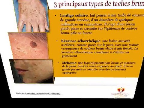 Types de taches brunes: mélasma, kératose, lentigo solaire...