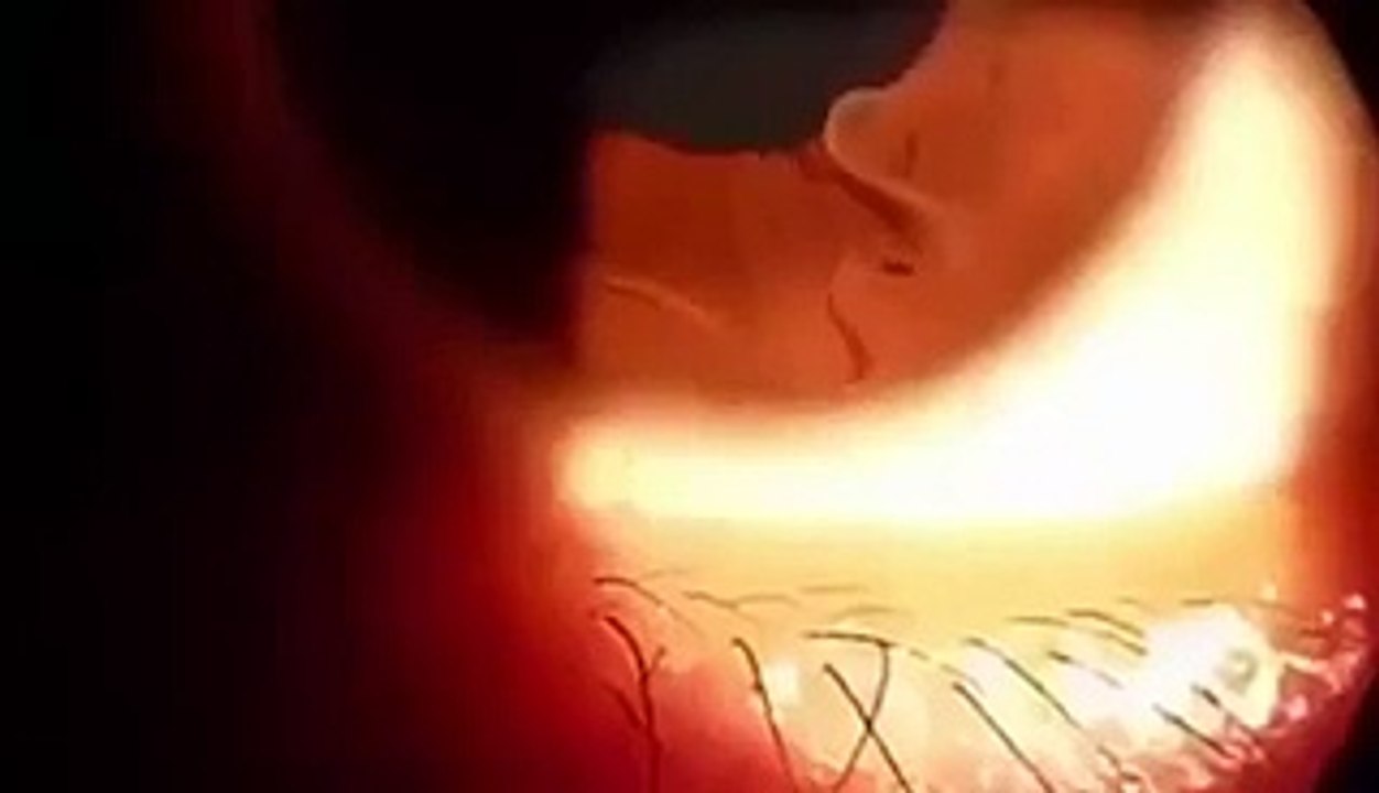 worm in eye