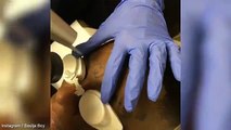 Soulja Boy gets laser treatment on his face to remove Gucci tattoo from his forehead