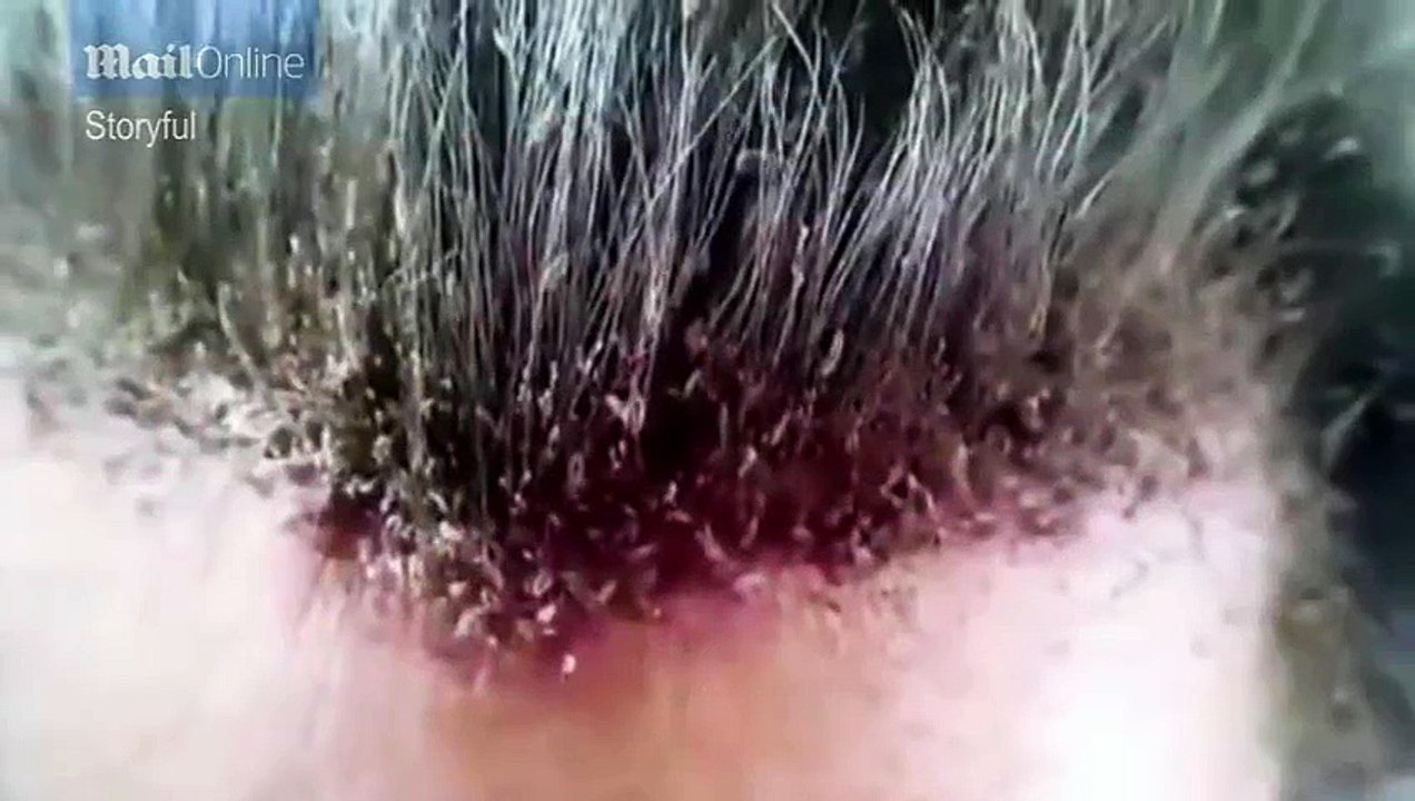The worst head lice video in the world (we have warned you!)