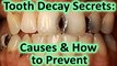 How to Prevent Tooth Decay Naturally & What Causes Tooth Decay * Stop Cavities