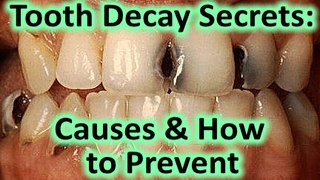 How to Prevent Tooth Decay Naturally & What Causes Tooth Decay * Stop Cavities