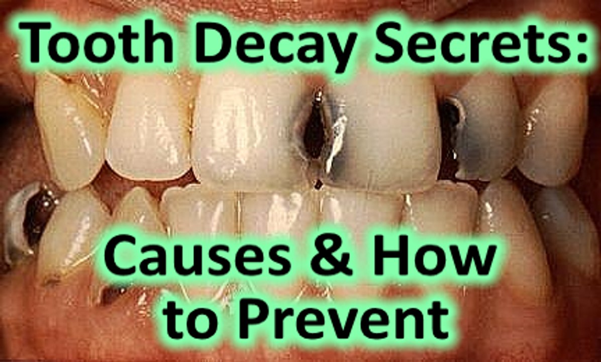 How to Prevent Tooth Decay Naturally & What Causes Tooth Decay * Stop Cavities