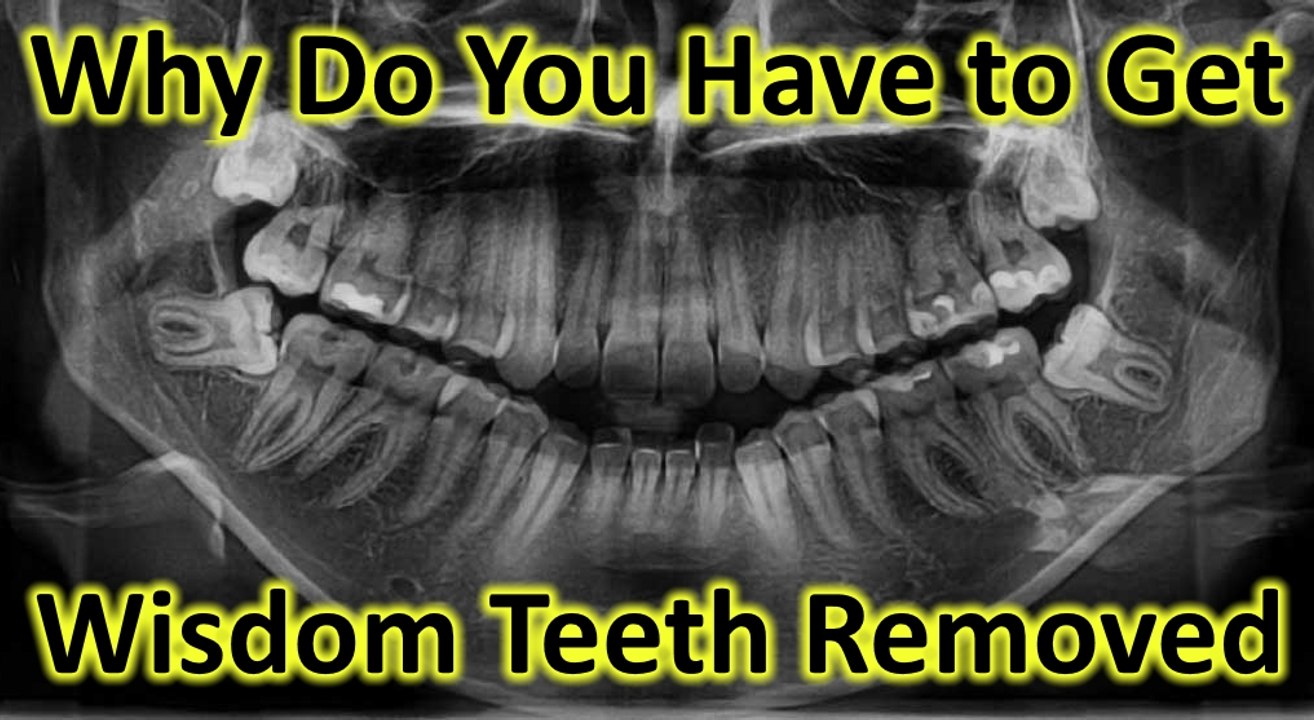 Why Do You Have to Get Wisdom Teeth Removed