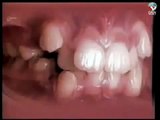Diş Teli Nasıl Çalışır?