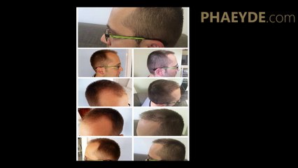 FUE Haartransplantation für Männer