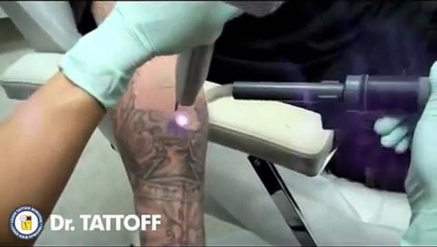 Tattoo removal on Arm by Laser is mesmerizing!