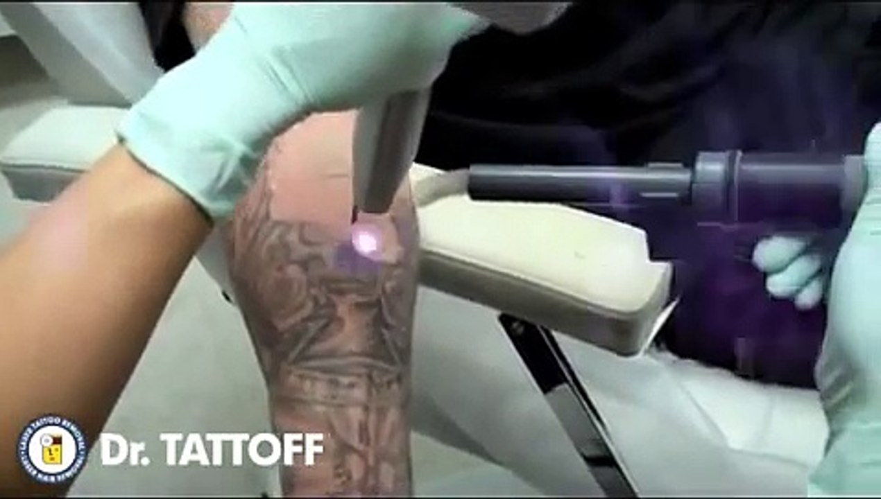 Tattoo removal on Arm by Laser is mesmerizing!