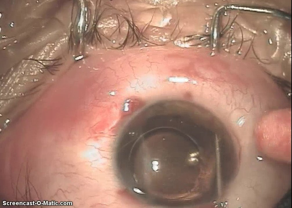 Pupil Cerclage Operation