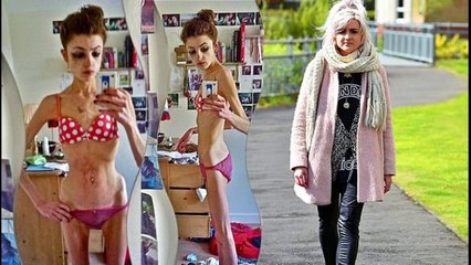 Tek Gecelik İlişki Genç Kızı İskelete Çevirdi