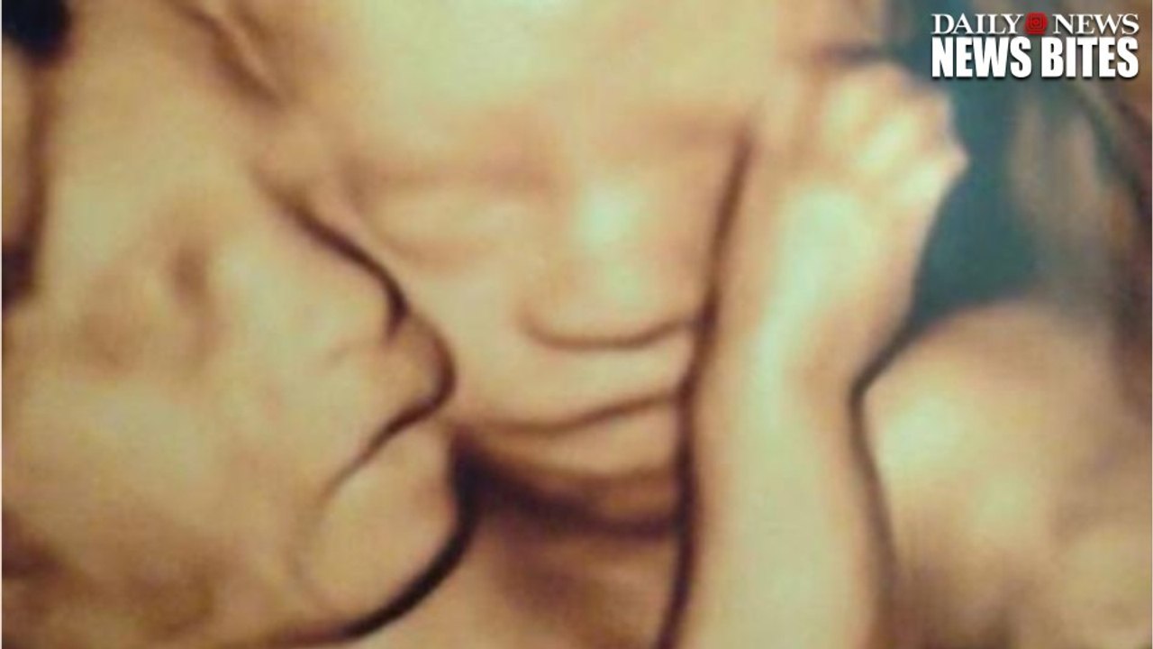 Minnesota Woman Birthed Conjoined Twins Banned From Visiting Surviving Baby