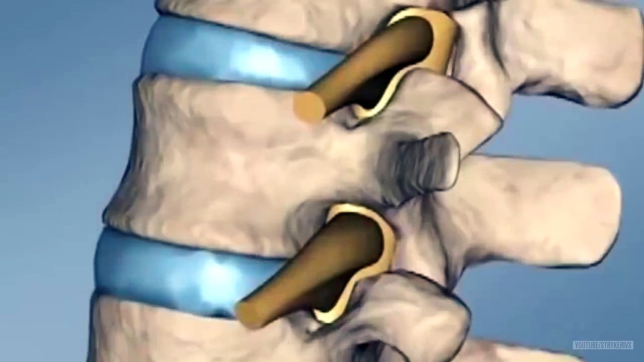 Foam Bone Treatment for Bone Fractures Orthopedic