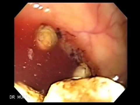 Colonic Diverticulosis and Diverticular Hemorrhage